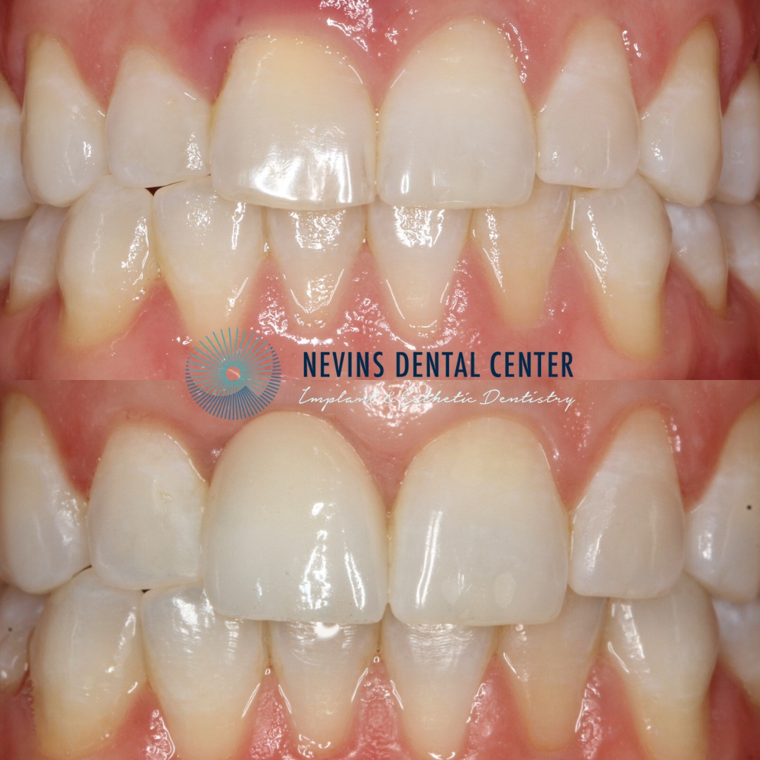 Crown and Bridge Restorations | Nevins Dental Center in Boston, MA This patient came to us with a periodontal infection and a root fracture, which required a dental implant