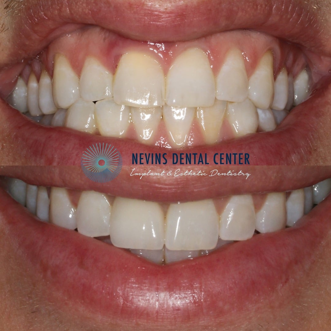 Crown and Bridge Restorations | Nevins Dental Center in Boston, MA This patient came to us with a periodontal infection and a root fracture, which required a dental implant
