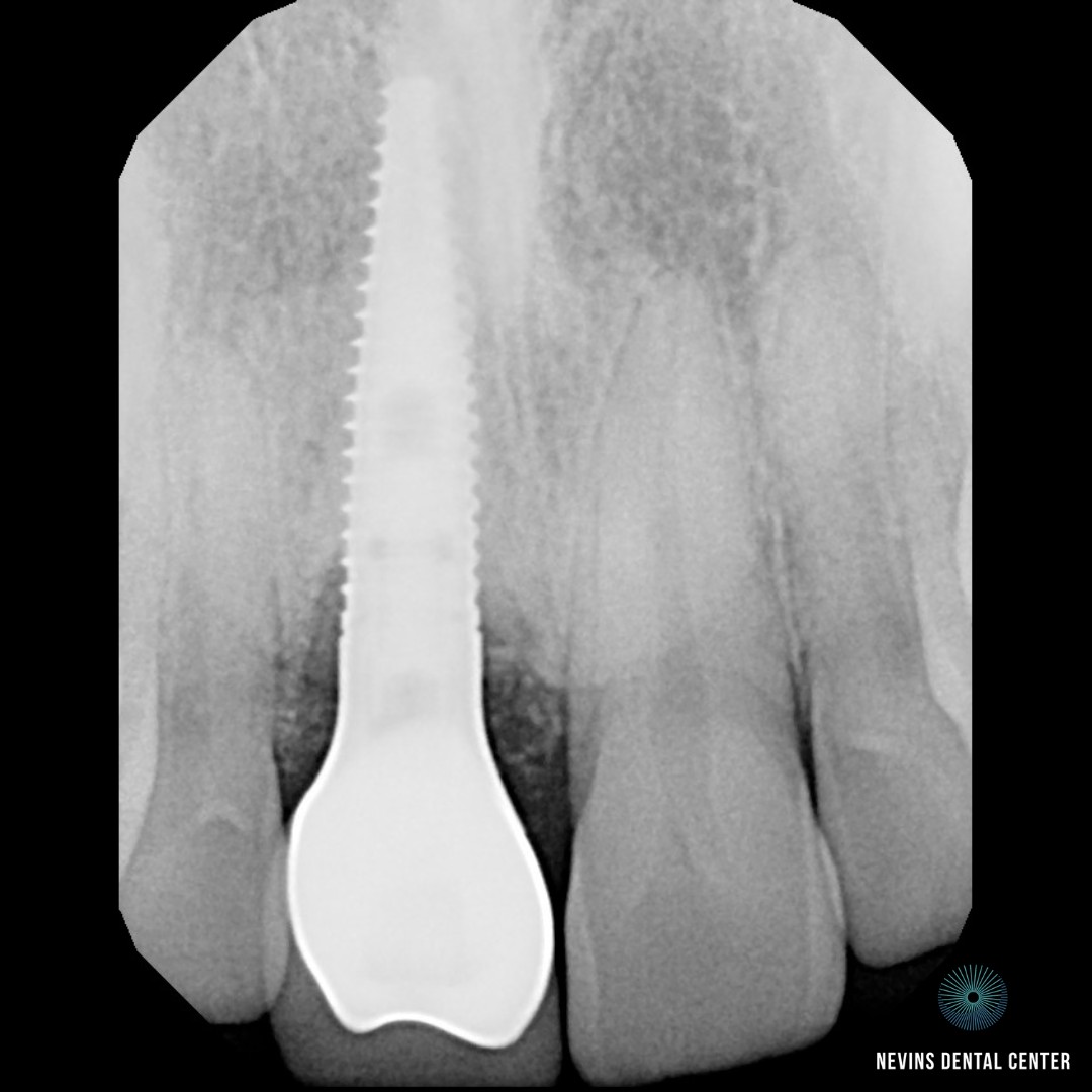 Crown and Bridge Restorations | Nevins Dental Center in Boston, MA This patient came to us with a periodontal infection and a root fracture, which required a dental implant