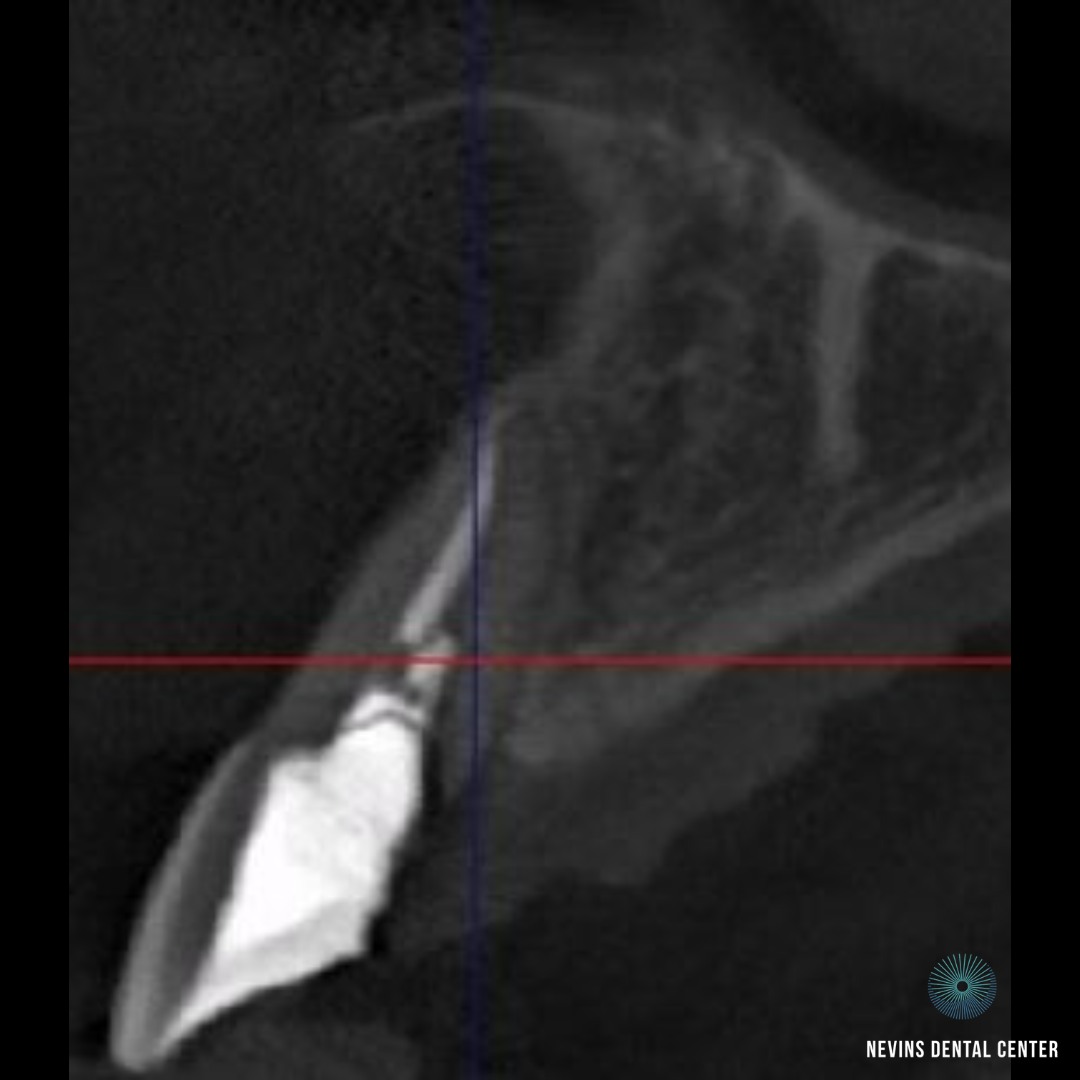 Crown and Bridge Restorations | Nevins Dental Center in Boston, MA This patient came to us with a periodontal infection and a root fracture, which required a dental implant