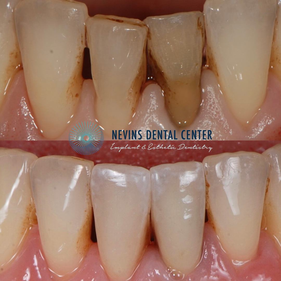 Smile Gallery | Nevins Dental Center in Boston, MA