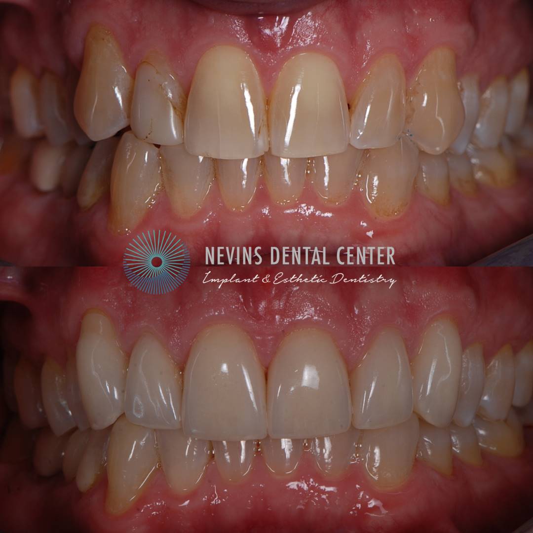 Smile Gallery | Nevins Dental Center in Boston, MA