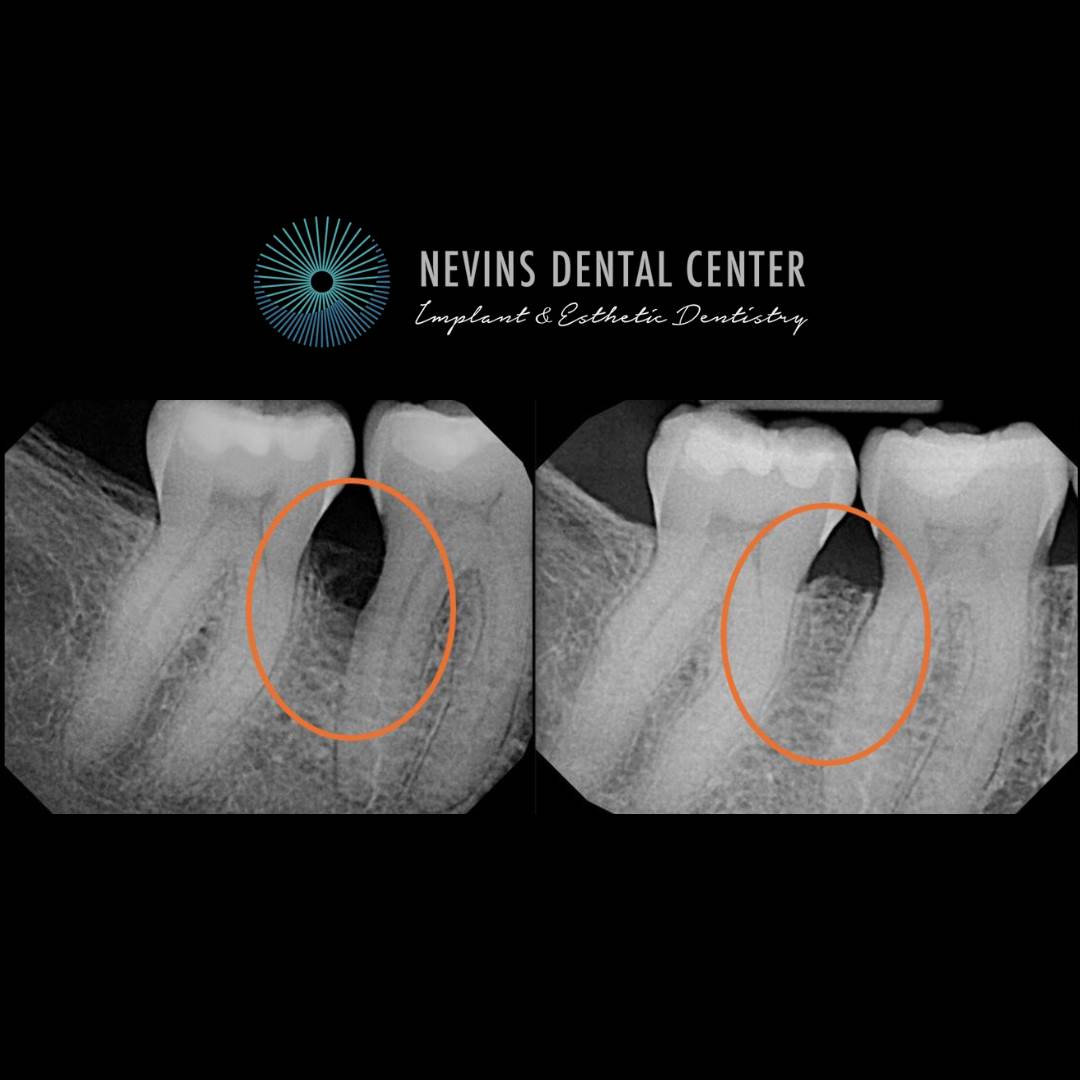 Smile Gallery | Nevins Dental Center in Boston, MA