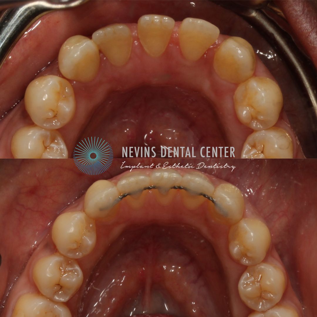 Smile Gallery | Nevins Dental Center in Boston, MA