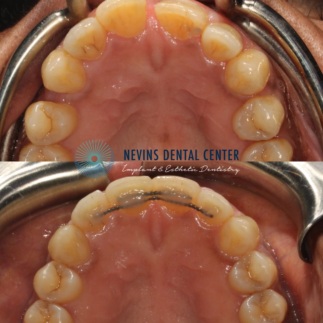 Smile Gallery | Nevins Dental Center in Boston, MA