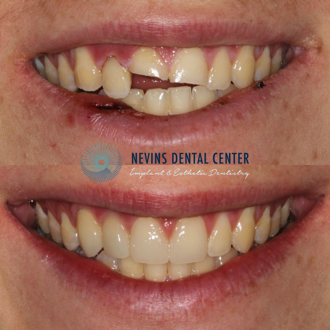 Crown and Bridge Restorations | Nevins Dental Center in Boston, MA Emergency care with root canal treatments