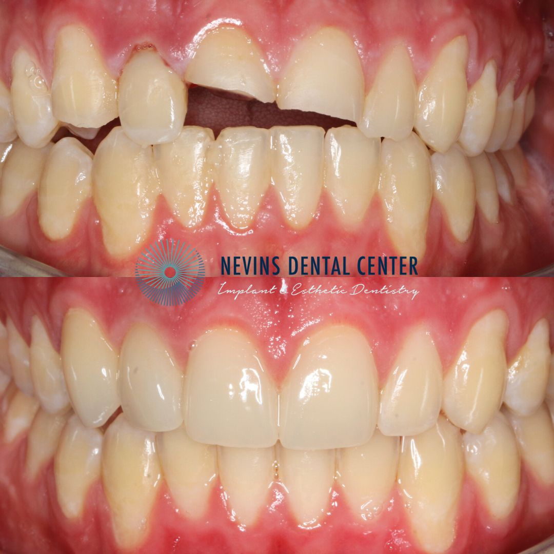 Crown and Bridge Restorations | Nevins Dental Center in Boston, MA Emergency care with root canal treatments