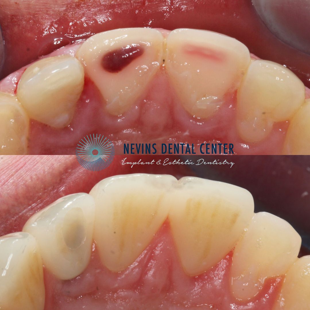 Crown and Bridge Restorations | Nevins Dental Center in Boston, MA Emergency care with root canal treatments