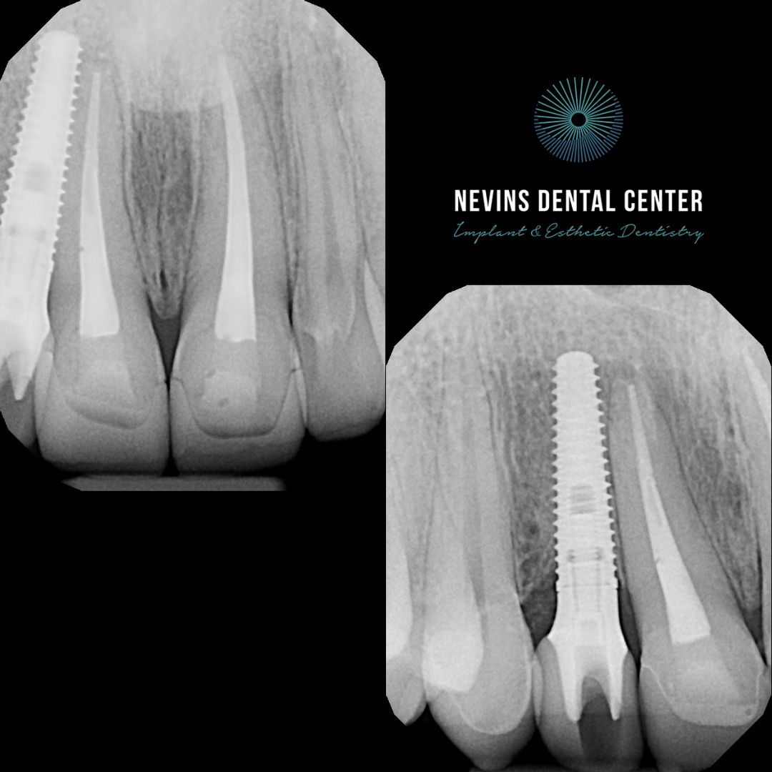 Crown and Bridge Restorations | Nevins Dental Center in Boston, MA Emergency care with root canal treatments