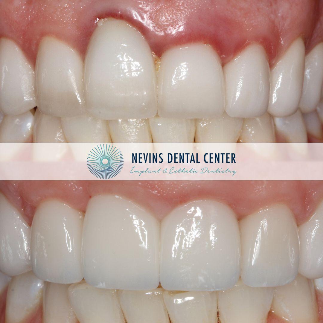 Crown and Bridge Restorations | Nevins Dental Center in Boston, MA This patient presented with significant gum recession affecting the right central tooth, ultimately requiring extraction Our team carefully planned and executed the placement of an implant-supported crown to achieve a natural-looking and functional esthetic result. The final outcome restored the patient's smile and confidence!