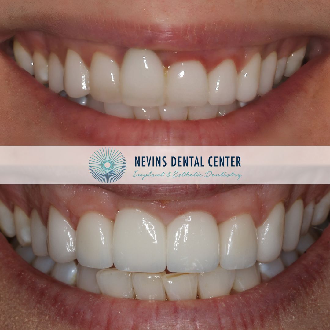 Crown and Bridge Restorations | Nevins Dental Center in Boston, MA This patient presented with significant gum recession affecting the right central tooth, ultimately requiring extraction Our team carefully planned and executed the placement of an implant-supported crown to achieve a natural-looking and functional esthetic result. The final outcome restored the patient's smile and confidence!