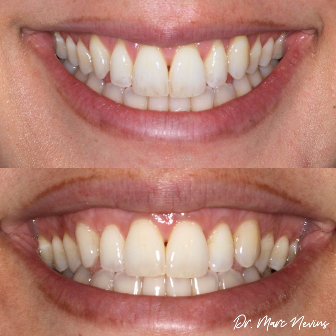 Smile Gallery | Nevins Dental Center in Boston, MA