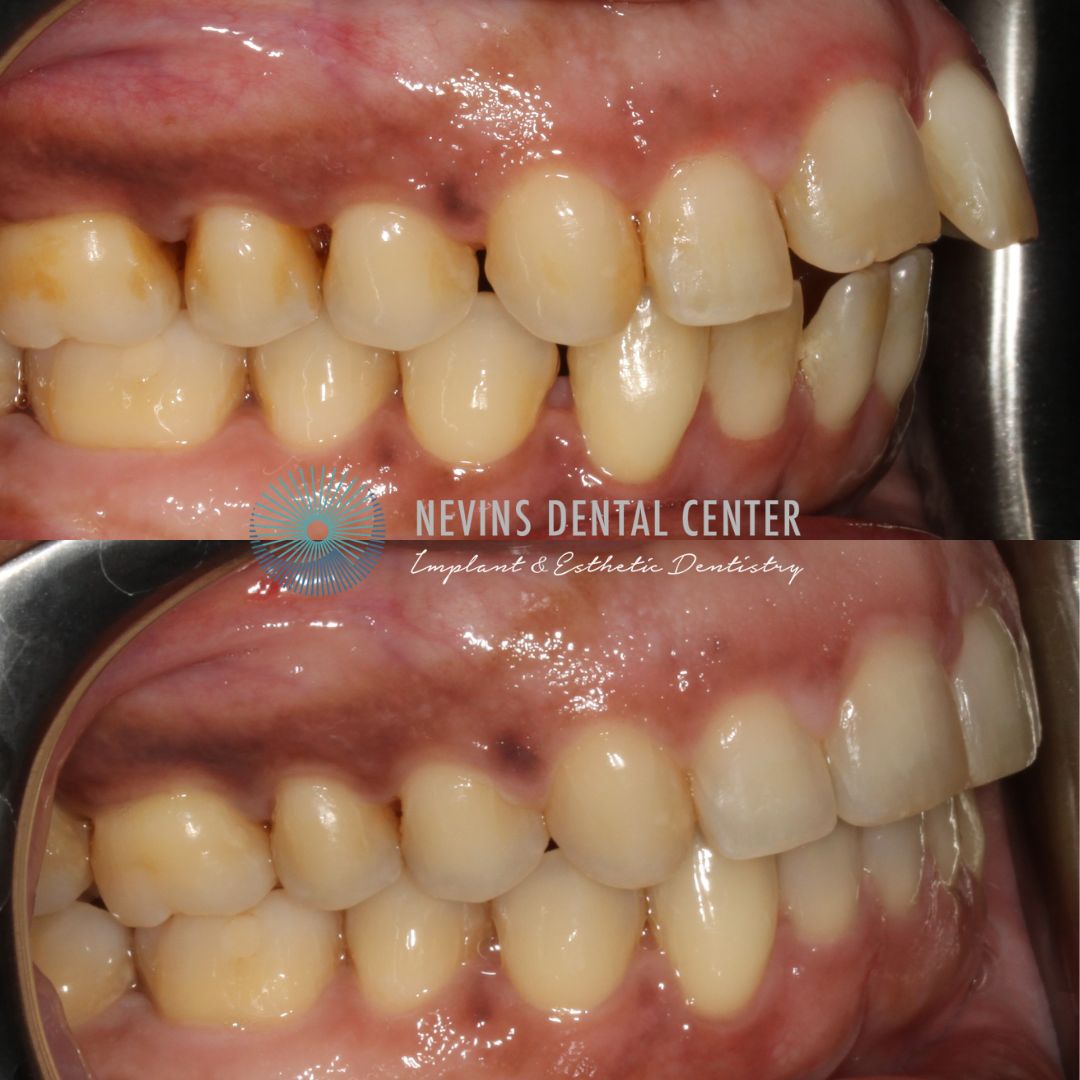 Smile Gallery | Nevins Dental Center in Boston, MA