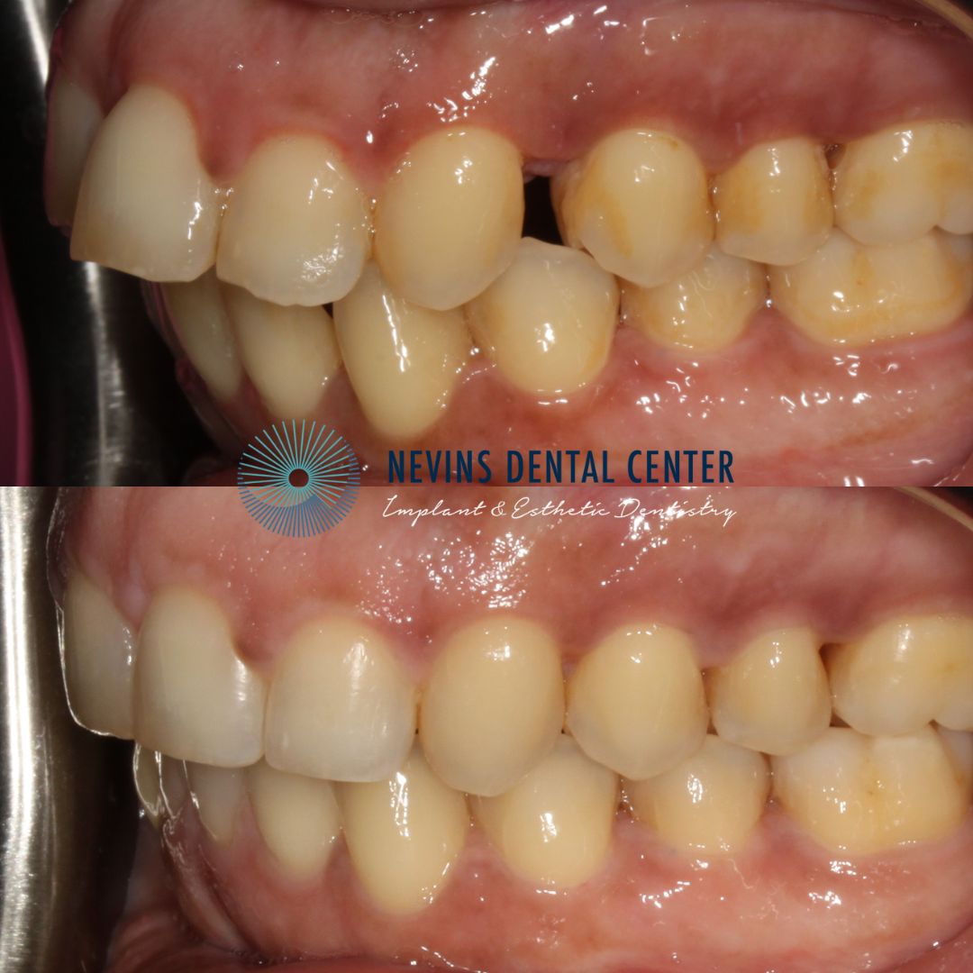 Smile Gallery | Nevins Dental Center in Boston, MA