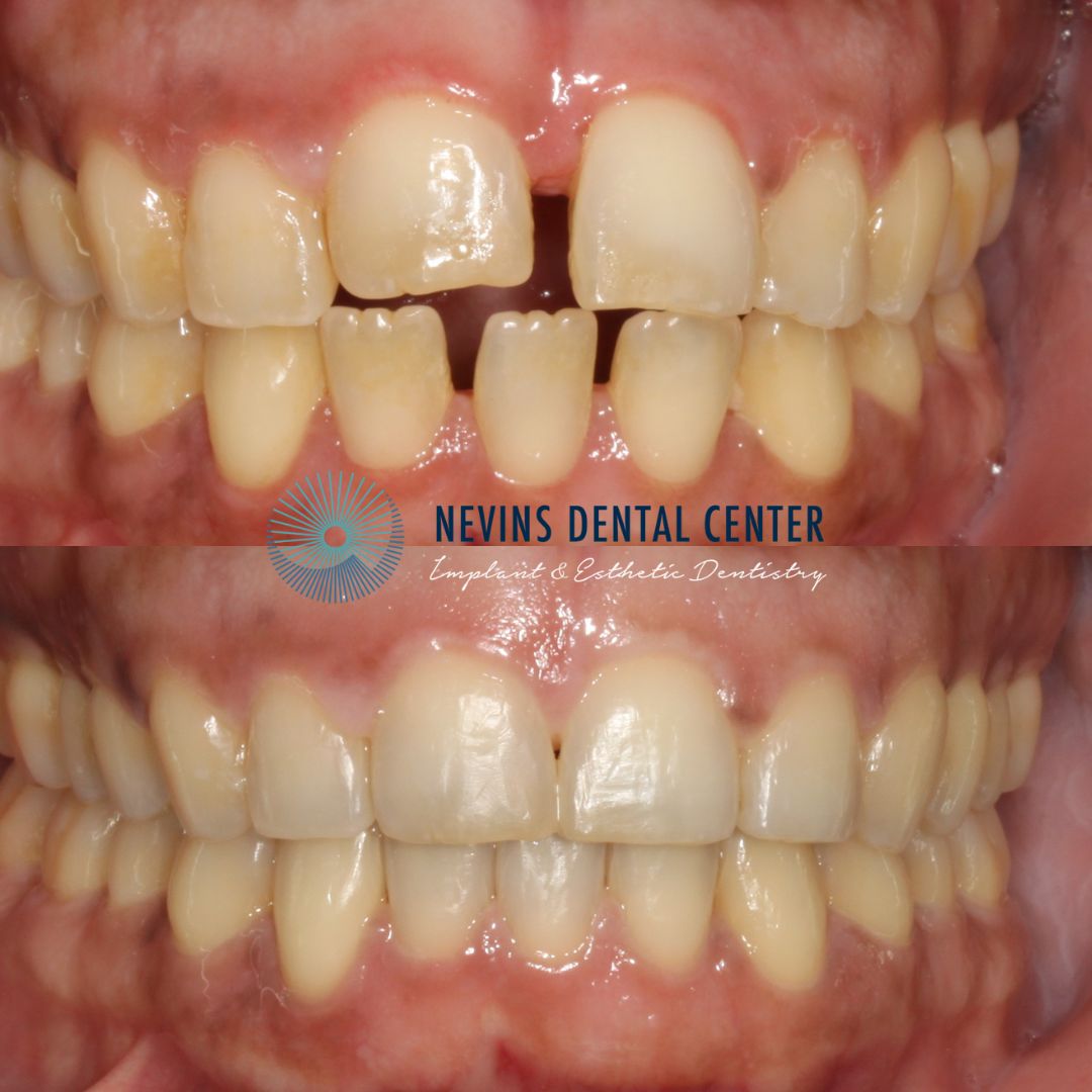 Smile Gallery | Nevins Dental Center in Boston, MA