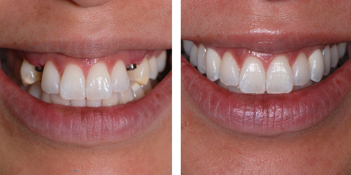 Dental Implants | Nevins Dental Center in Boston, MA