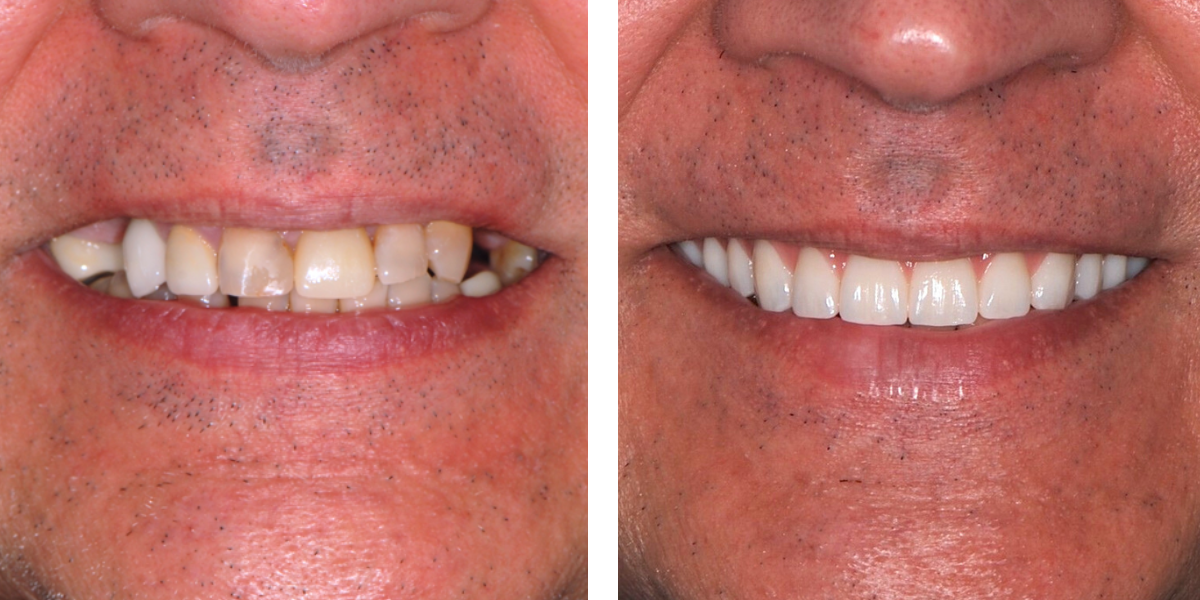 Dental Implants | Nevins Dental Center in Boston, MA