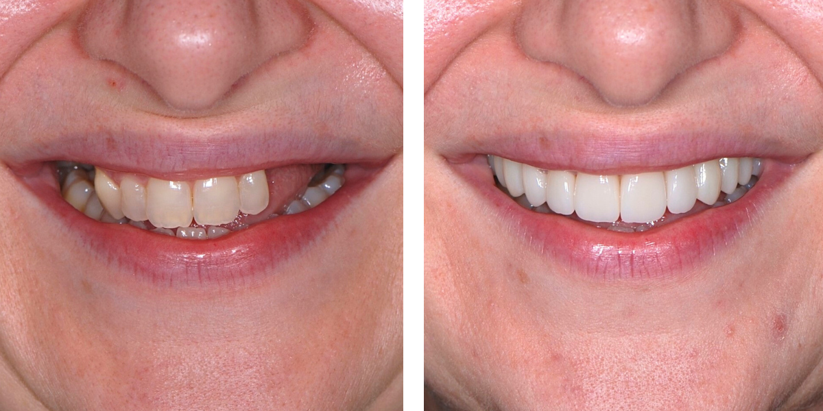 Dental Implants | Nevins Dental Center in Boston, MA