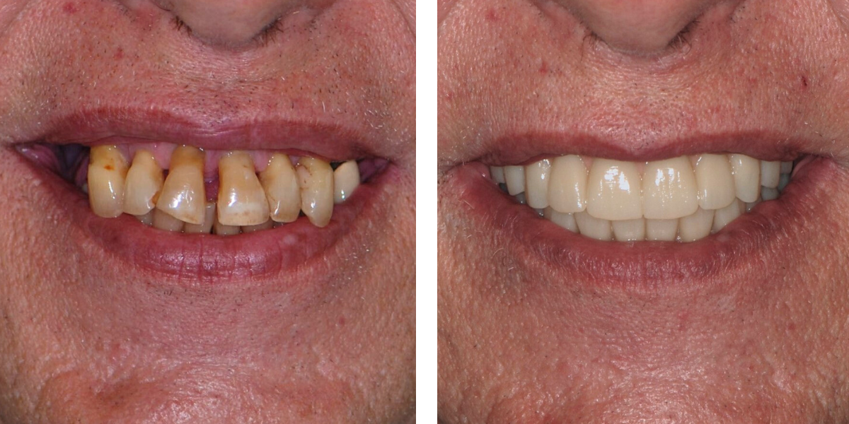 Dental Implants | Nevins Dental Center in Boston, MA