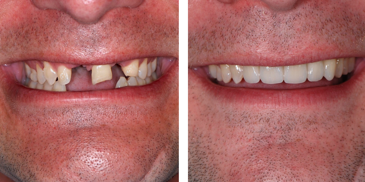 Dental Implants | Nevins Dental Center in Boston, MA