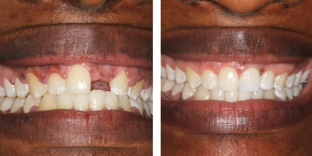 Dental Implants | Nevins Dental Center in Boston, MA