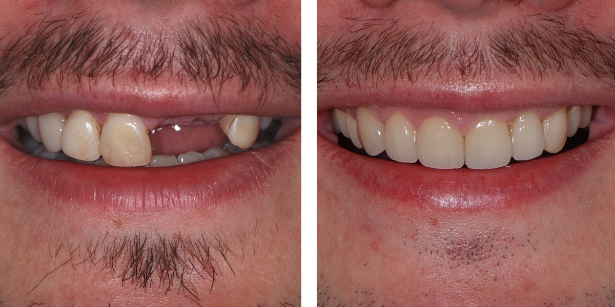 Dental Implants | Nevins Dental Center in Boston, MA