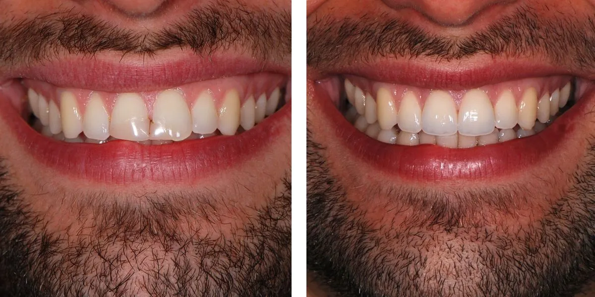 Before and after treatment Nevins Dental Center