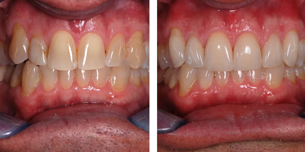 Before and after treatment Nevins Dental Center