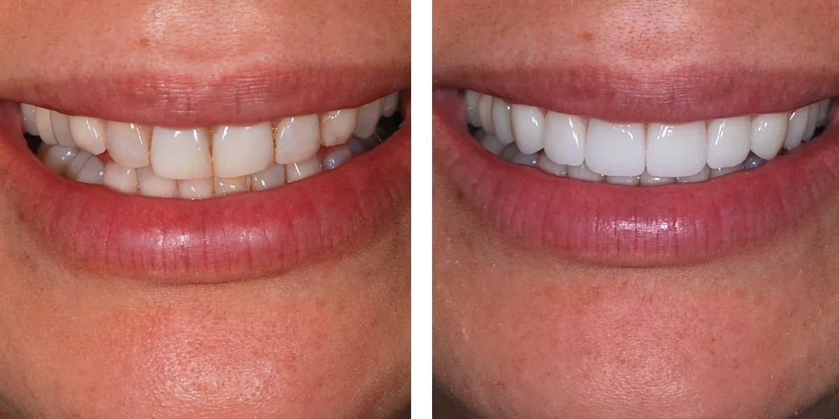 Before and after treatment Nevins Dental Center