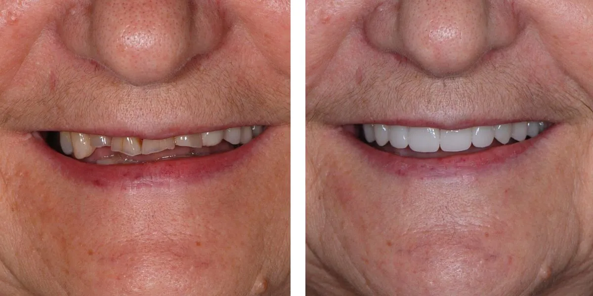 Before and after treatment Nevins Dental Center