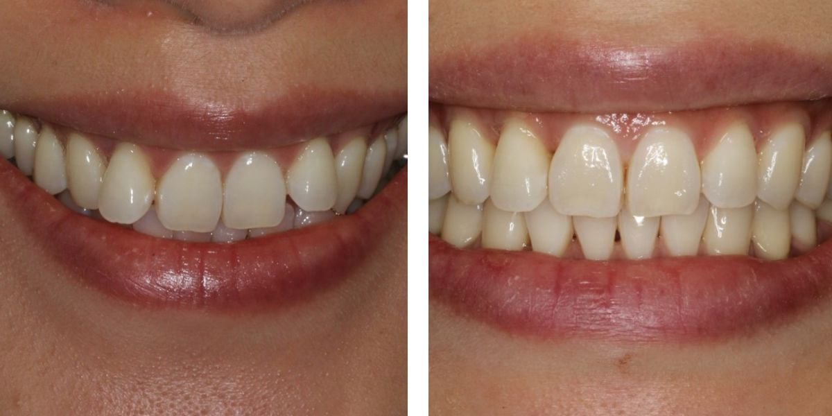 before and after treatment at Nevins Dental Center