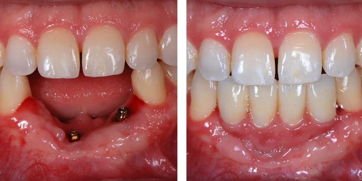 Before and after treatment Nevins Dental Center