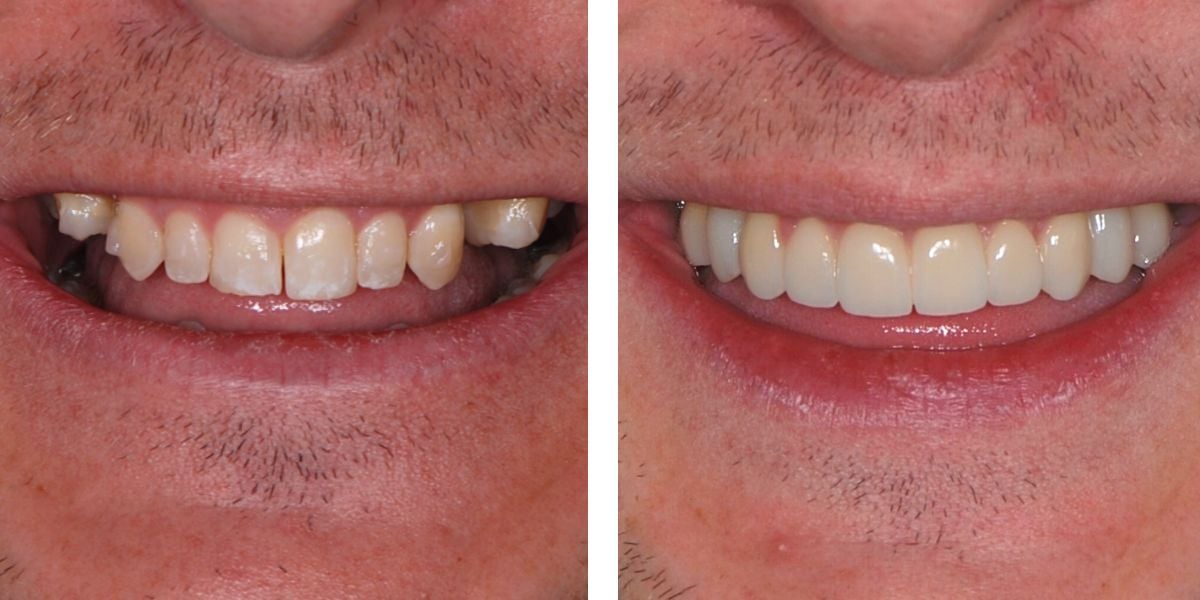 Before and after treatment Nevins Dental Center