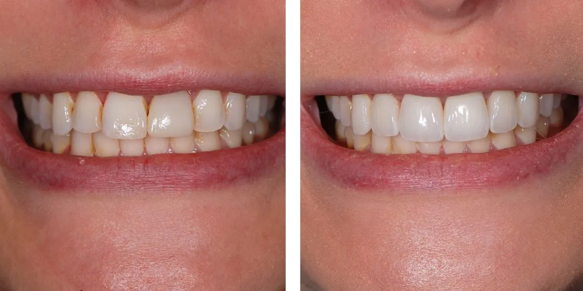 Before and after treatment Nevins Dental Center