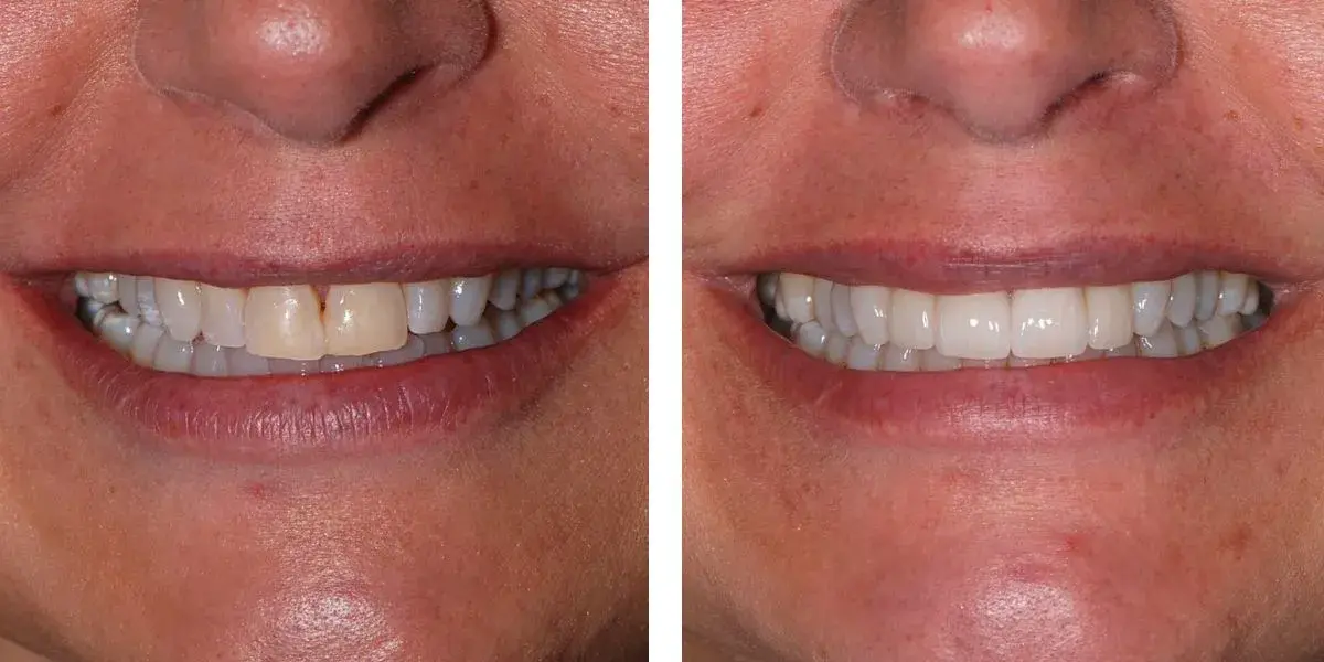 Before and after treatment Nevins Dental Center