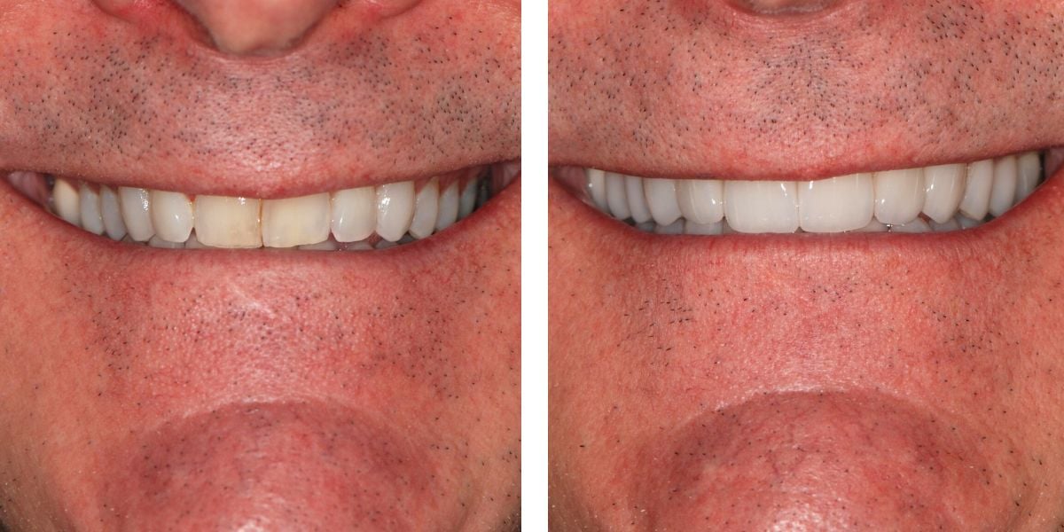 Before and after treatment Nevins Dental Center