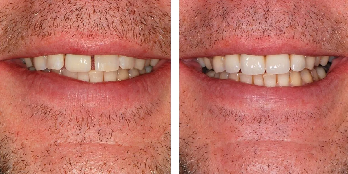 Before and after treatment Nevins Dental Center