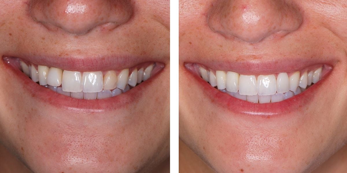Before and after treatment Nevins Dental Center
