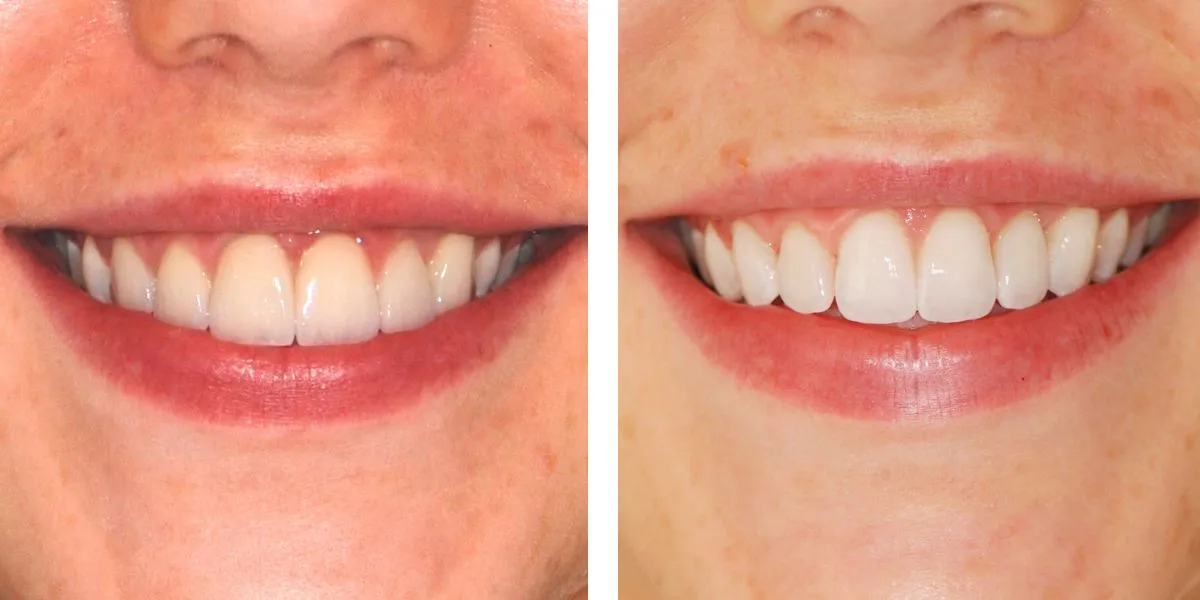 Before and after treatment Nevins Dental Center