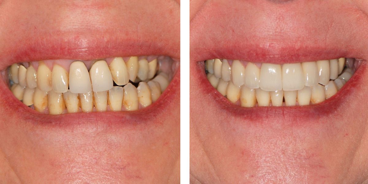 Before and after treatment Nevins Dental Center