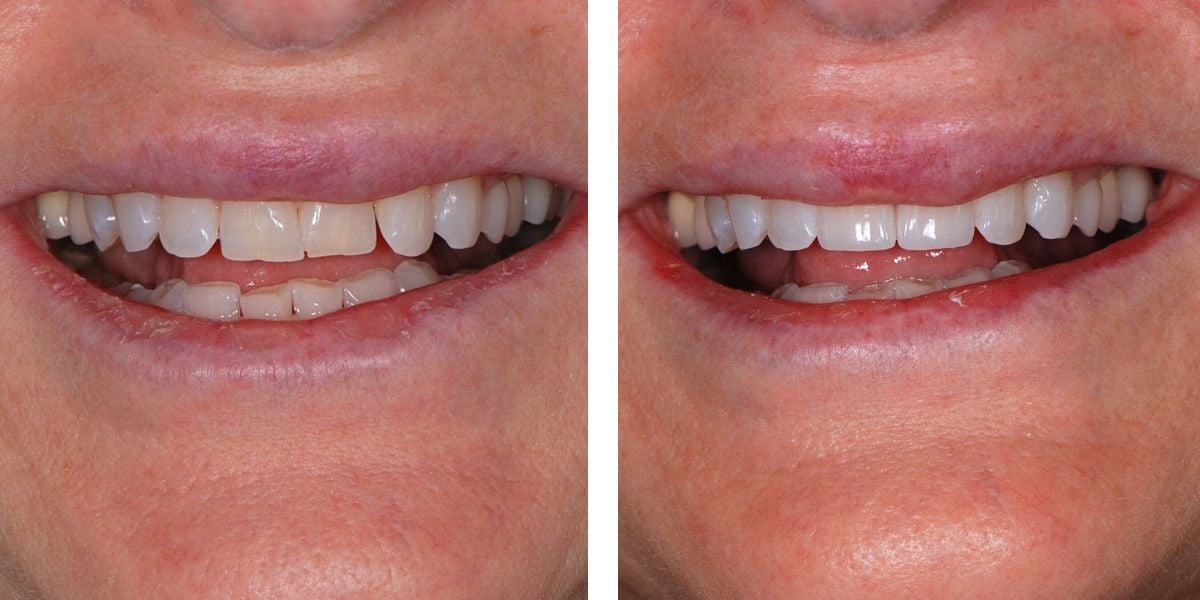 Before and after treatment Nevins Dental Center