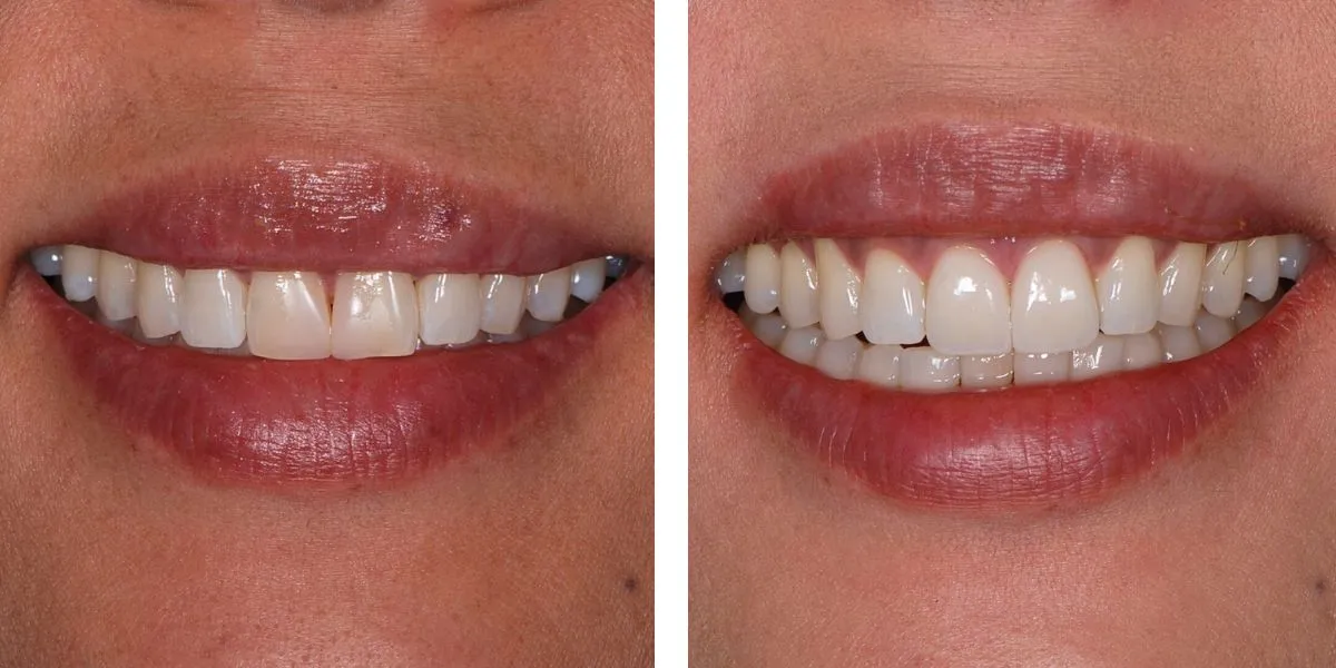 Before and after treatment Nevins Dental Center