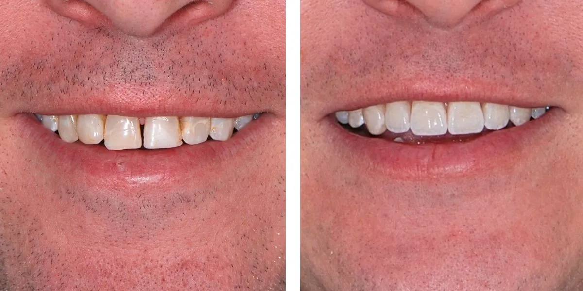 Before and after treatment Nevins Dental Center