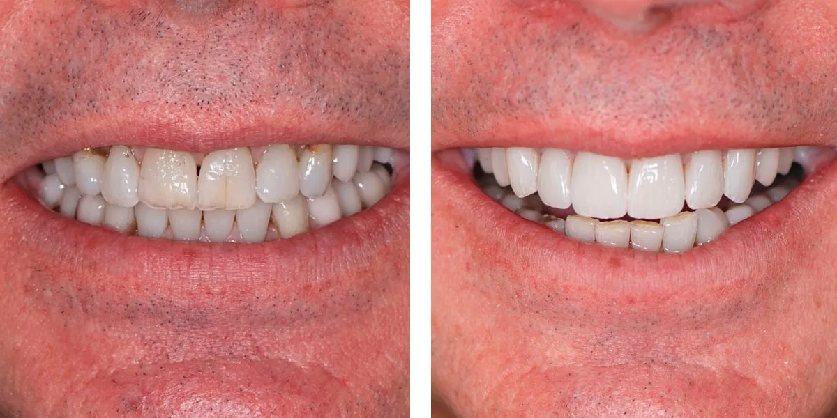 Before and after treatment Nevins Dental Center