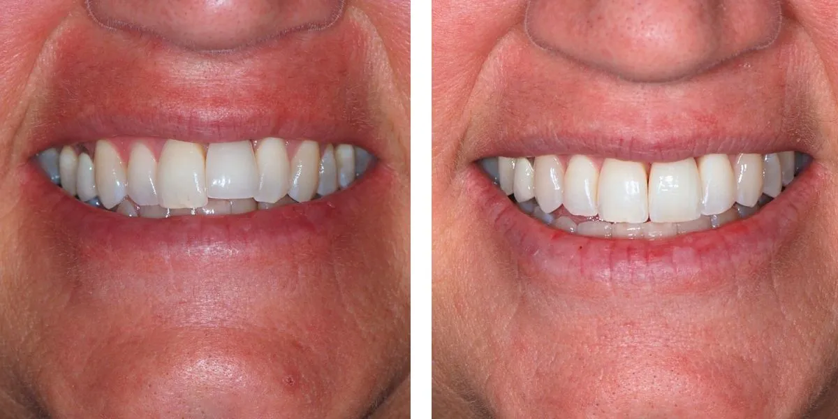 Before and after treatment Nevins Dental Center