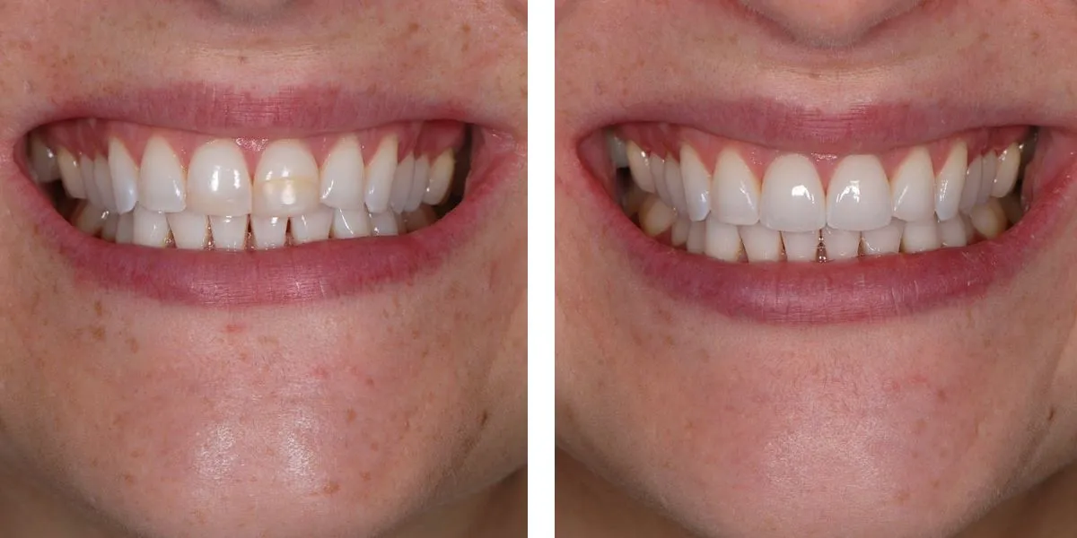 Before and after treatment Nevins Dental Center