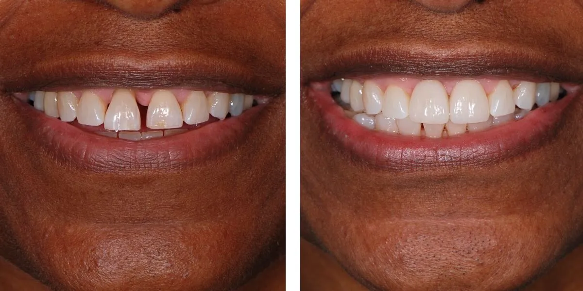 Before and after treatment Nevins Dental Center