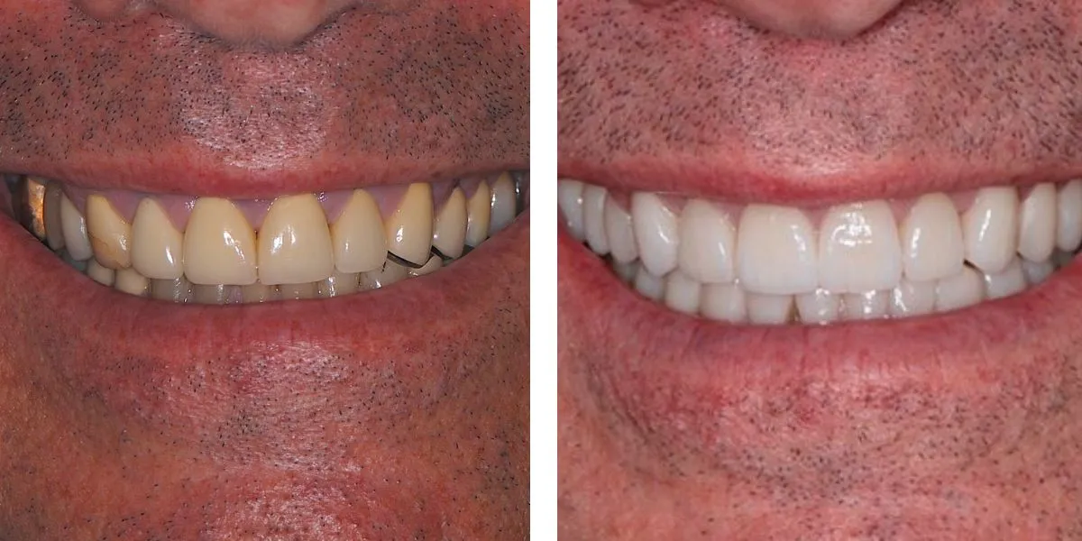 Before and after treatment Nevins Dental Center
