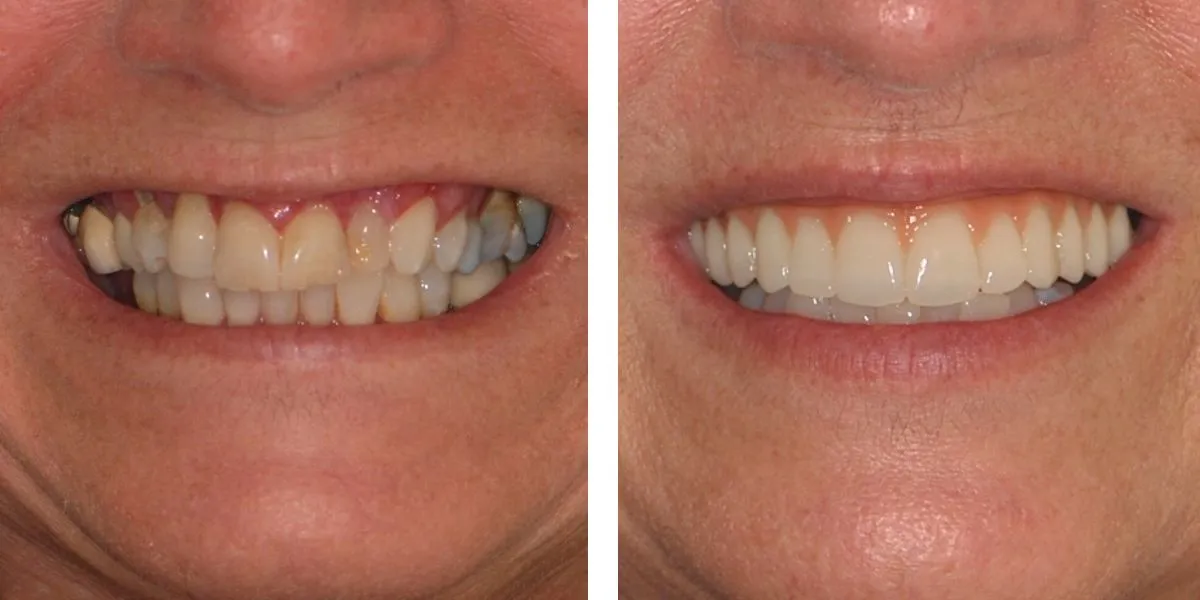 Before and after treatment Nevins Dental Center