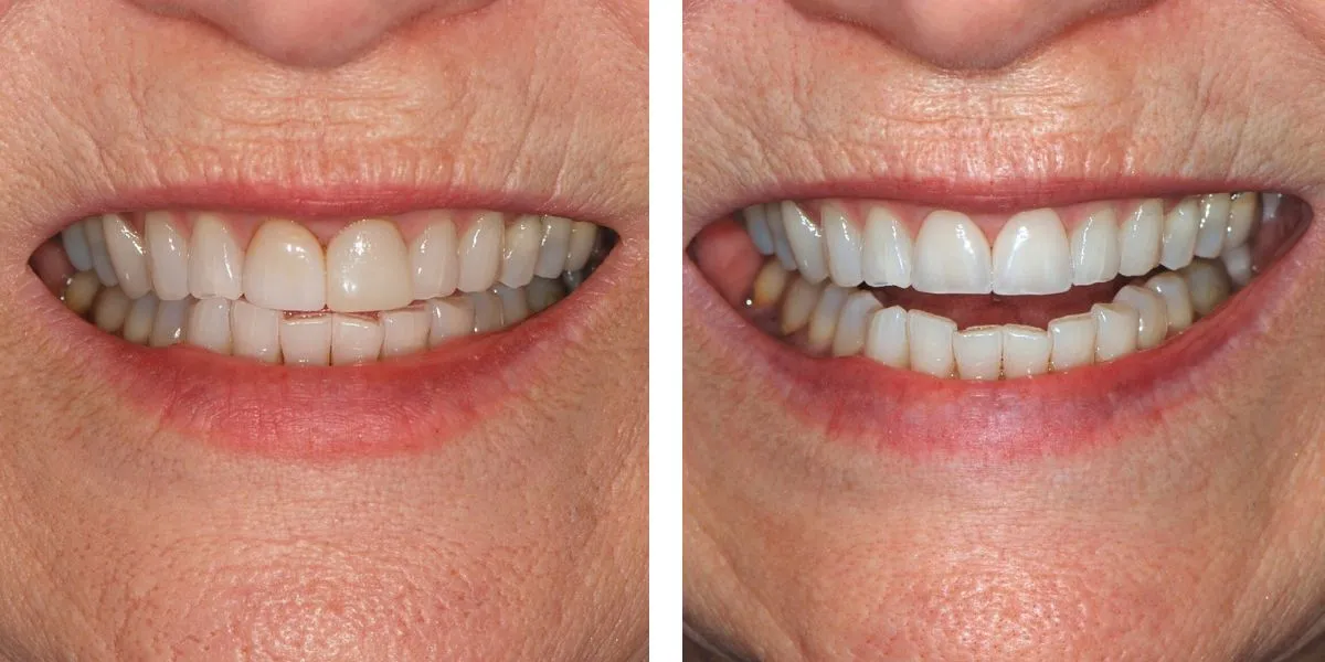 Before and after treatment Nevins Dental Center